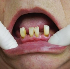 Jae-Lee-Teeth-Partial-Dentures-before-1
