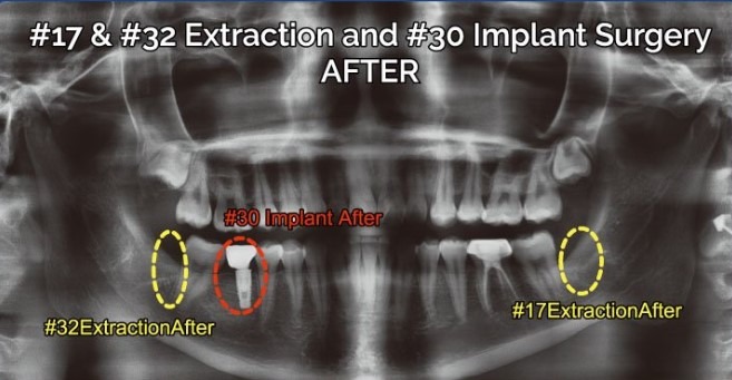 Jae-Lee-Tooth-Extraction-after-1