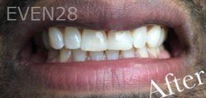 Jianghua-Wang-Bioclear-Dental-Fillings-after-1