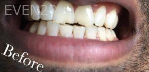 Jianghua-Wang-Bioclear-Dental-Fillings-before-1