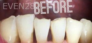 Jianghua-Wang-Bioclear-Dental-Fillings-before-2