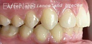 Jianghua-Wang-Orthodontics-Braces-after-1