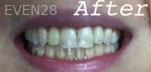 Jianghua-Wang-Orthodontics-Braces-after-3