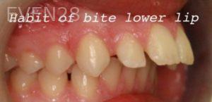 Jianghua-Wang-Orthodontics-Braces-before-1