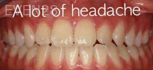 Jianghua-Wang-Orthodontics-Braces-before-2