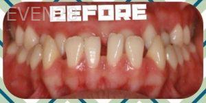 Jianghua-Wang-Orthodontics-Braces-before-4