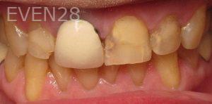 John-Abajian-Dental-Crowns-before-1