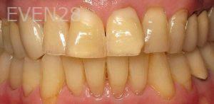 John-Abajian-Dental-Crowns-before-2