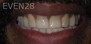 Jose-Luis-Ruiz-Dental-Bonding-after-4