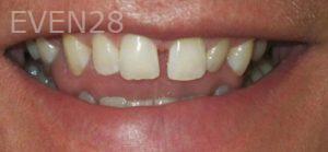 Jose-Luis-Ruiz-Dental-Bonding-before-1