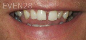 Jose-Luis-Ruiz-Dental-Bonding-before-3