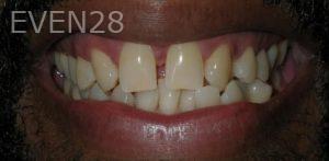 Jose-Luis-Ruiz-Dental-Bonding-before-4