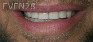 Jose-Luis-Ruiz-Dental-Crowns-after-1