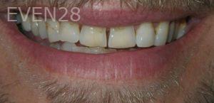 Jose-Luis-Ruiz-Dental-Crowns-before-1