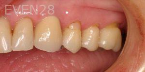 Jose-Luis-Ruiz-Dental-Implants-after-1
