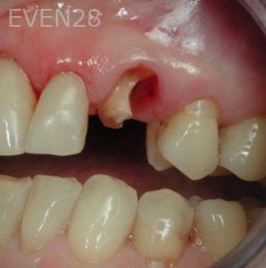 Jose-Luis-Ruiz-Dental-Implants-before-1