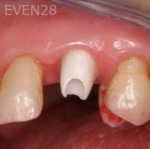 Jose-Luis-Ruiz-Dental-Implants-before-1b