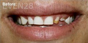 Joseph-Lee-Dental-Crowns-before-2