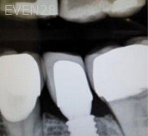 Joseph-Lee-Dental-Implants-after-3