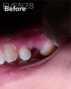 Joseph-Lee-Dental-Implants-before-1