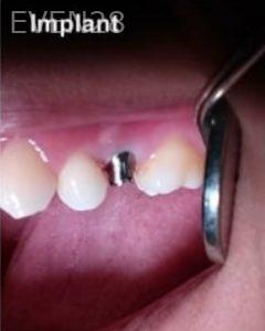 Joseph-Lee-Dental-Implants-before-1b