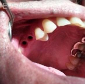 Joseph-Lee-Dental-Implants-before-2