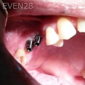 Joseph-Lee-Dental-Implants-before-2c