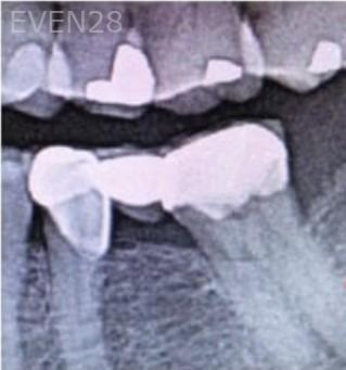 Joseph-Lee-Dental-Implants-before-3
