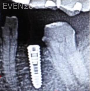 Joseph-Lee-Dental-Implants-before-3b