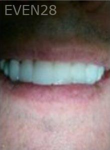Joseph-Lee-Full-Mouth-Dental-Implants-after-1b