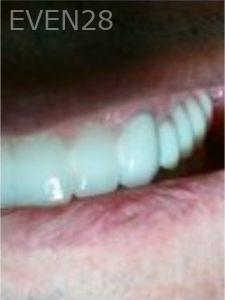 Joseph-Lee-Full-Mouth-Dental-Implants-after-1c