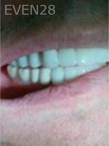 Joseph-Lee-Full-Mouth-Dental-Implants-after-1d