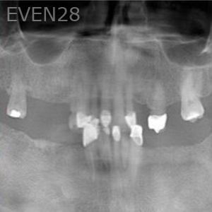 Joseph-Lee-Full-Mouth-Dental-Implants-before-1