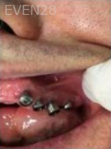 Joseph-Lee-Full-Mouth-Dental-Implants-before-1c