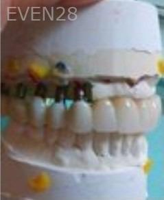 Joseph-Lee-Full-Mouth-Dental-Implants-before-1d