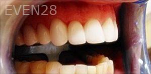 Joseph-Lee-Teeth-Whitening-before-1