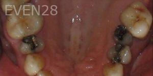 Kiumars-Rahimi-Dental-Crowns-before-1