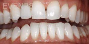 Kiumars-Rahimi-Dental-Implants-after-2