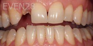 Kiumars-Rahimi-Dental-Implants-before-2