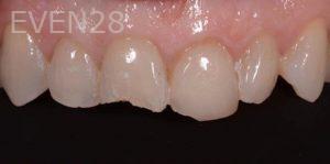 Lawrence-Fung-Dental-Bonding-before-6