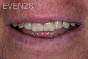 Lawrence-Toomin-Dental-Implants-after-1
