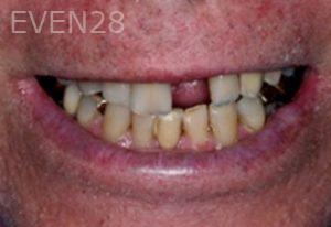 Lawrence-Toomin-Dental-Implants-before-1b