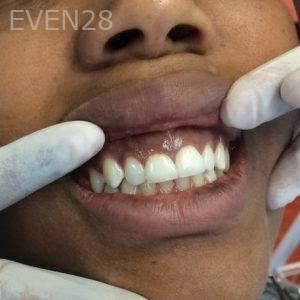 Luis-Herrera-Dental-Crowns-after-2