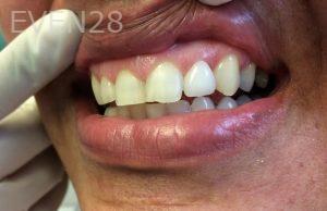Luis-Herrera-Dental-Crowns-after-3