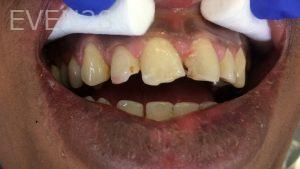 Luis-Herrera-Dental-Crowns-before-1