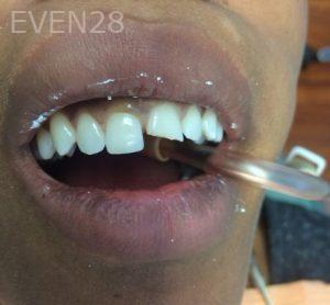 Luis-Herrera-Dental-Crowns-before-2