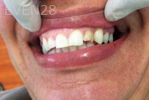 Luis-Herrera-Dental-Crowns-before-3