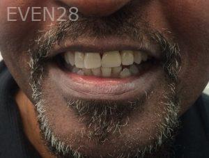 Luis-Herrera-Dental-Implants-after-1