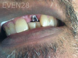 Luis-Herrera-Dental-Implants-before-1