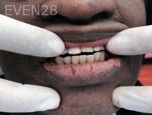 Luis-Herrera-Partial-Dentures-after-1
